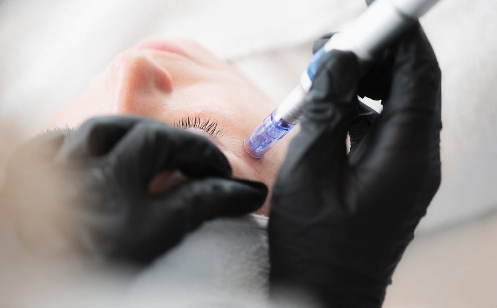 Microneedling