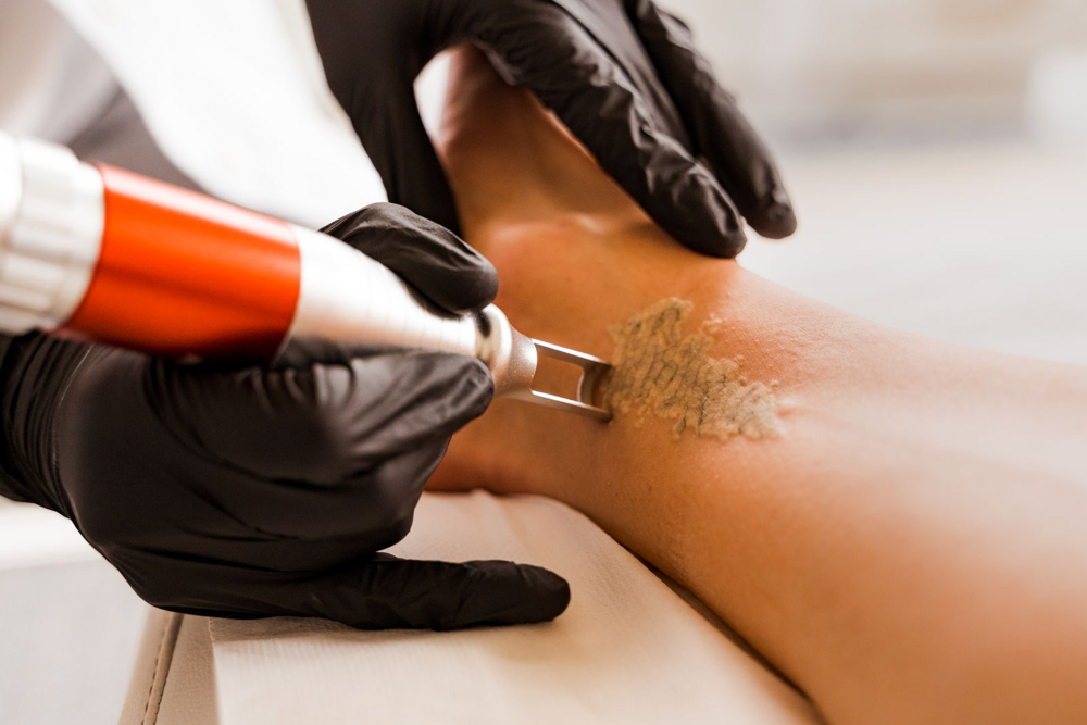Tattoo verwijdering