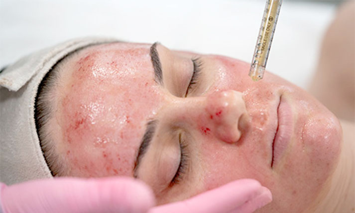Vampire Facial (PRP)